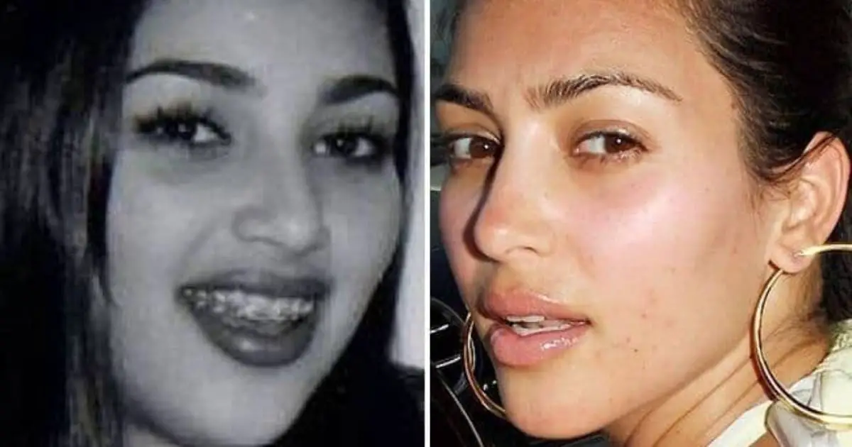 Kim Kardashian Before (1995) and After Braces (2003)