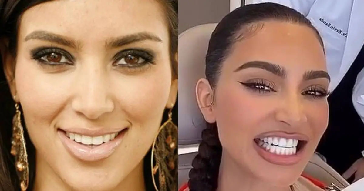 Kim Kardashian Before (2008) and After Veneers (2024)