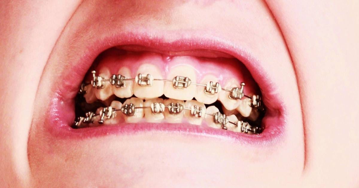 Gold Braces: Elastics vs Brackets Style Guide