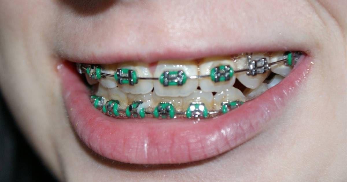 Green Braces: Mint to Neon Green Style Guide