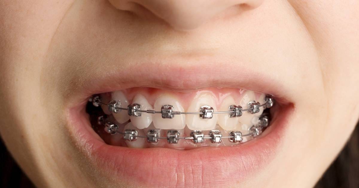 Silver & Gray Braces: Subtle Style Guide