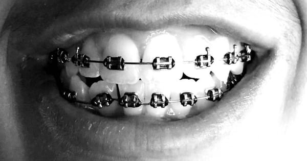 Black Braces: Sleek Style Guide & Color Combinations