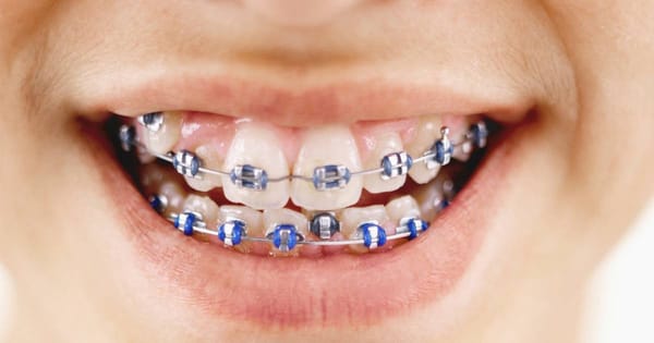 Blue Braces Colors: Navy to Turquoise Style Guide