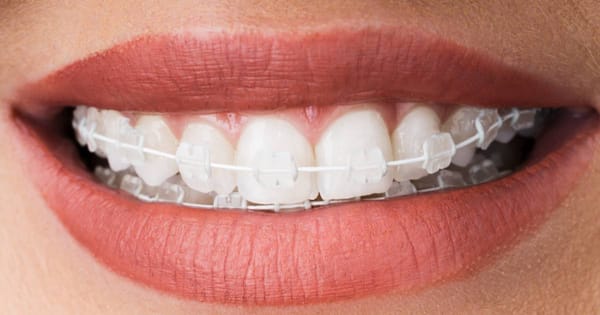 Clear Braces Elastics: Invisible Look & Care Tips