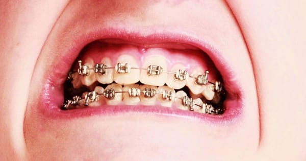 Gold Braces: Elastics vs Brackets Style Guide