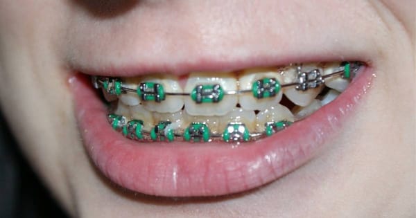 Green Braces: Mint to Neon Green Style Guide