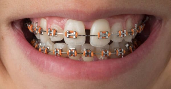 Orange Braces: Neon to Peach Style Guide
