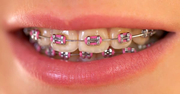 Pink Braces Guide: Hot Pink to Baby Pink Styles