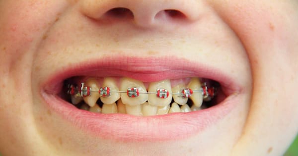 Red Braces Guide: Bold Shades & Styling Tips for Teens