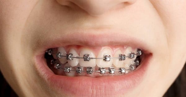 Silver & Gray Braces: Subtle Style Guide