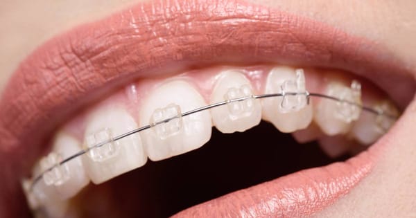 White Braces: Staining Risks & Care Guide