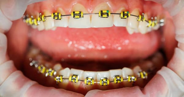 Yellow Braces: Cautionary Guide & Styling Tips